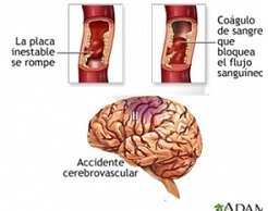 Cuando se Rompe el Cerebro
